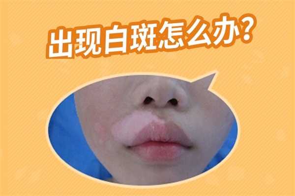 老年白癜风怎么治疗比较好